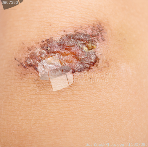 Image of wound on skin