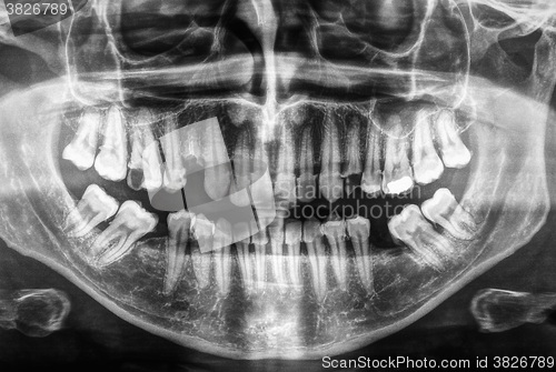 Image of Human teeth xray in black and white