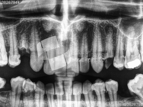 Image of Human teeth xray in black and white