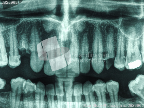 Image of Human teeth xray
