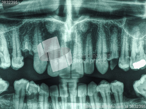 Image of Human teeth xray