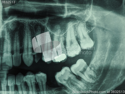 Image of Human teeth xray