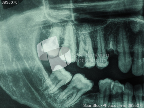Image of Human teeth xray