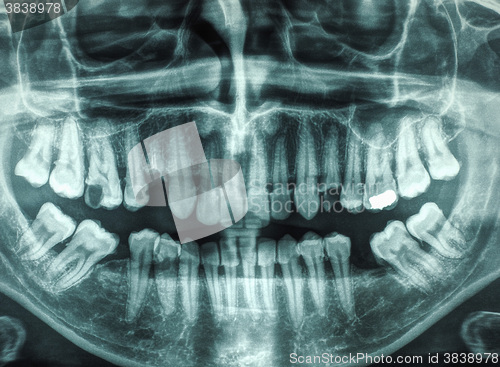 Image of Human teeth xray