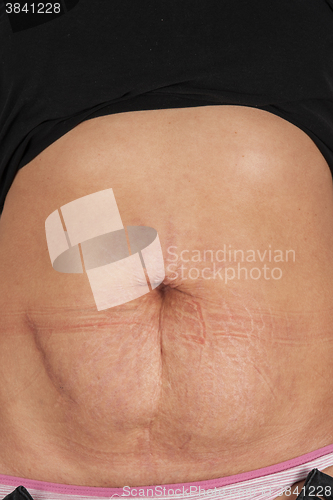 Image of female belly with stretch marks