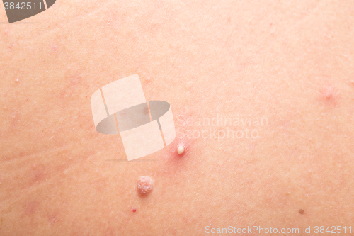 Image of mole and pimple