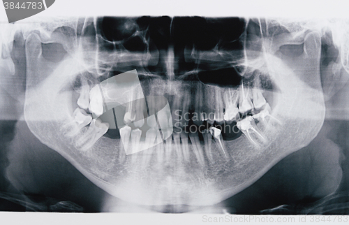 Image of panoramic x-ray skan