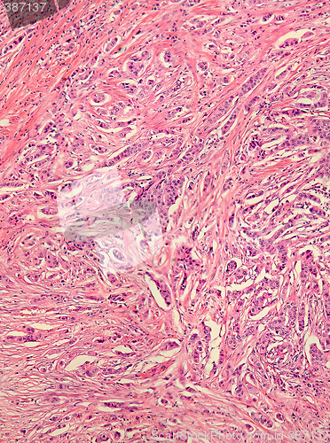 Image of Breast Cancer