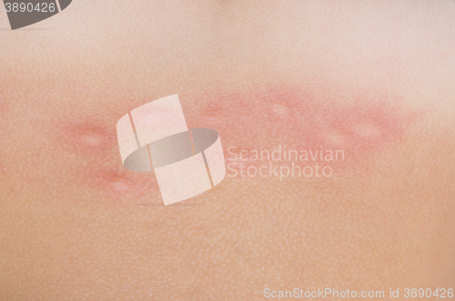 Image of mosquito bites on skin