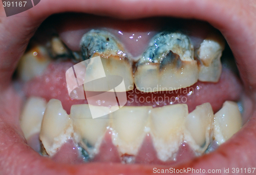 Image of Severe Tooth Decay