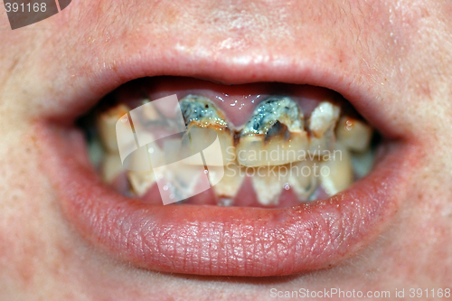 Image of Mouth with Severe Tooth Decay