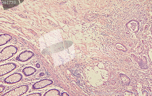 Image of Colon Cancer Histology