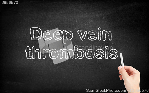 Image of Deep Vein Thrombosis