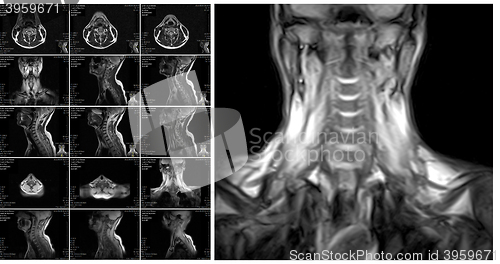 Image of Magnetic resonance imaging of the cervical spine.