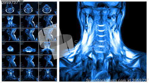 Image of Magnetic resonance imaging of the cervical spine.