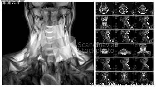 Image of Magnetic resonance imaging of the cervical spine.