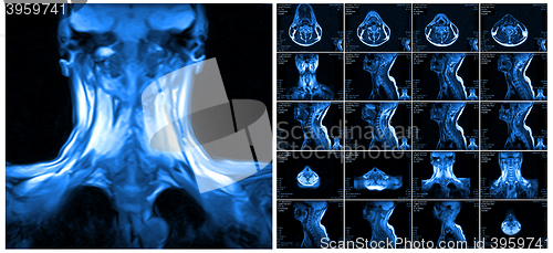 Image of Magnetic resonance imaging of the cervical spine.