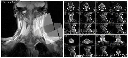 Image of Magnetic resonance imaging of the cervical spine.