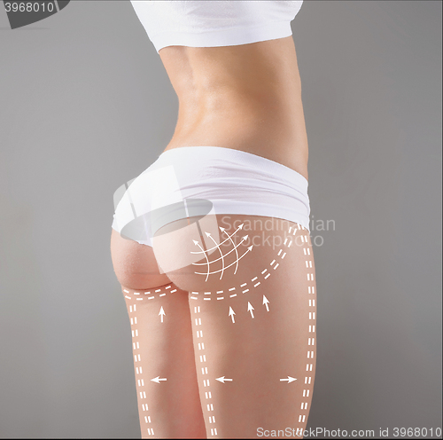 Image of Marks on the women\'s buttocks, waist and legs before plastic surgery.