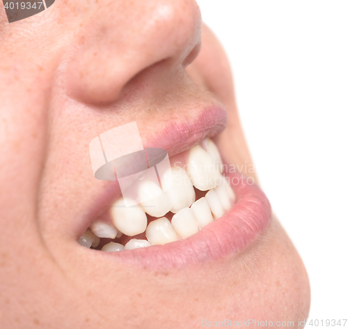 Image of woman crooked teeth