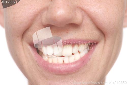 Image of woman crooked teeth