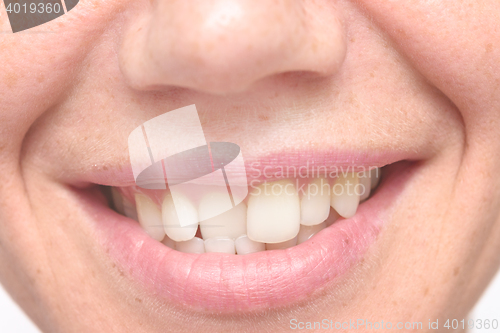 Image of woman crooked teeth
