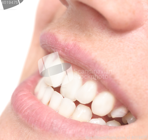 Image of woman crooked teeth