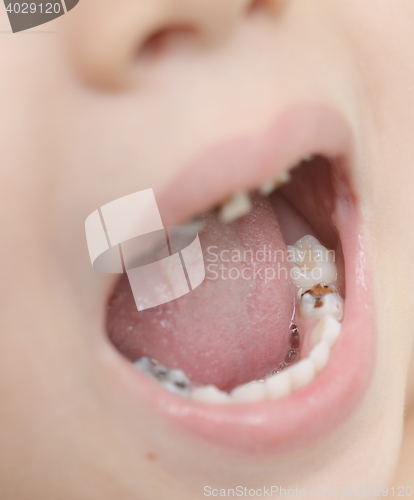 Image of baby teeth with caries