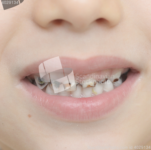 Image of baby teeth with caries