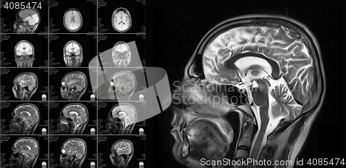 Image of Magnetic resonance imaging of the brain