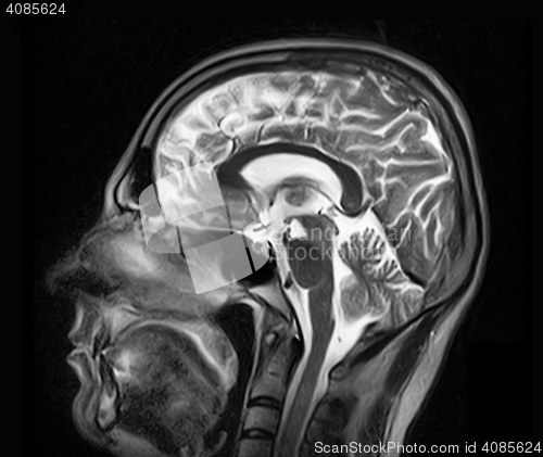 Image of Magnetic resonance imaging of the brain