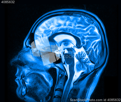 Image of Magnetic resonance imaging of the brain