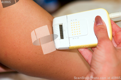 Image of epilation