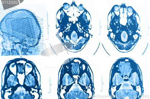 Image of CT and MRI of the skull