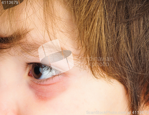 Image of Pink eye on a boy child, at closeup with brown eye and brunette 