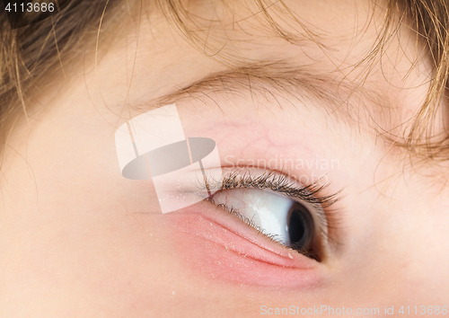 Image of Pink eye on a boy child, at closeup with brown eye and brunette 