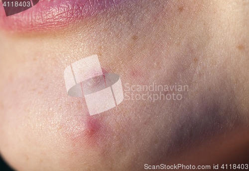 Image of pimple on the chin