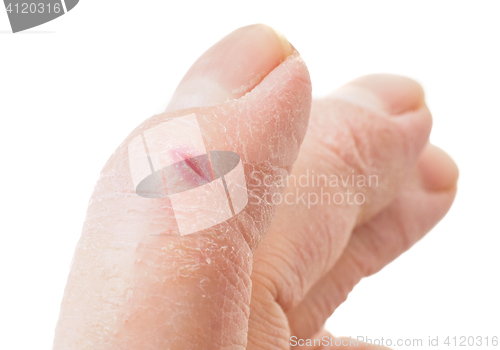 Image of Closeup of finger with infected cut, isolated on white backgroun
