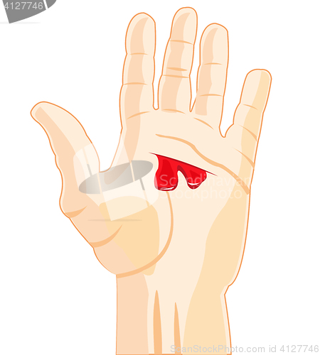 Image of Wound on hand