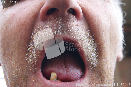 Image of Mouth with rotten teeth