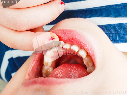 Image of Closeup of finger feeling a lose tooth in a little girls mouth