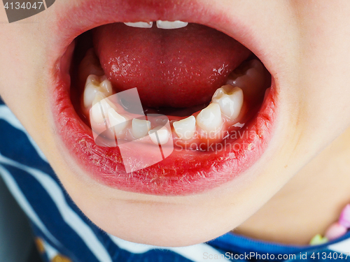 Image of Closeup of lose tooth in a little girls mouth