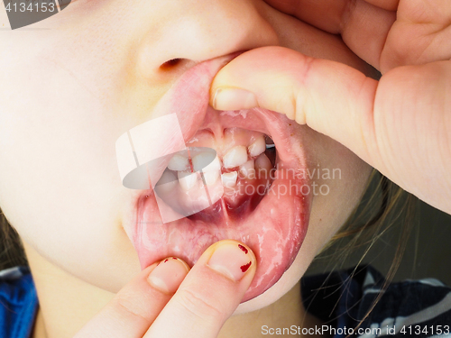 Image of Closeup of a little persons mouth, with a lose tooth