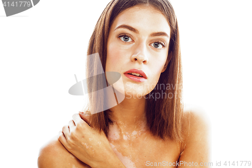 Image of beautiful young brunette woman with vitiligo disease close up isolated on white positive smiling, model problems concept, bad tan problem