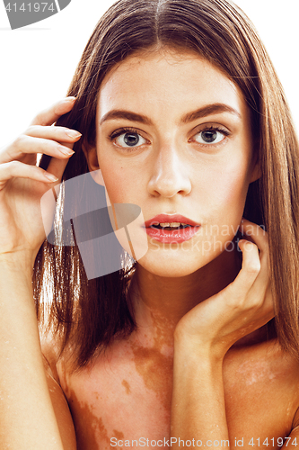 Image of beautiful young brunette woman with vitiligo disease close up isolated on white positive smiling, model problems concept, bad tan problem