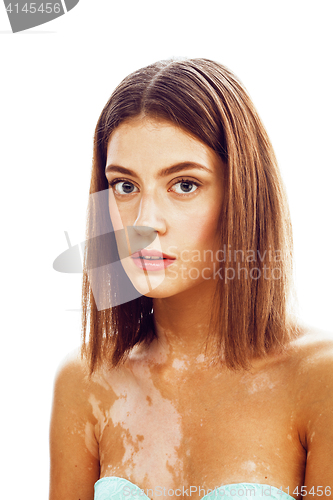 Image of beautiful young brunette woman with vitiligo disease close up isolated on white positive smiling, model problems concept, bad tan problem