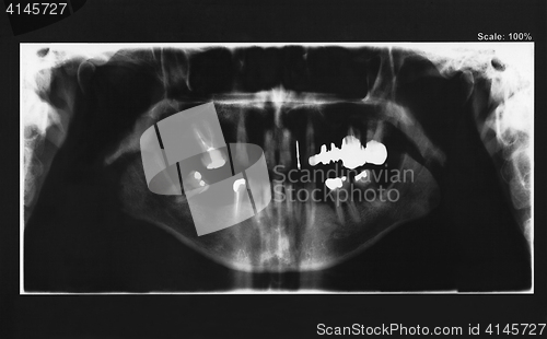 Image of Dental Xray 