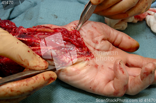 Image of Hand Surgery 2
