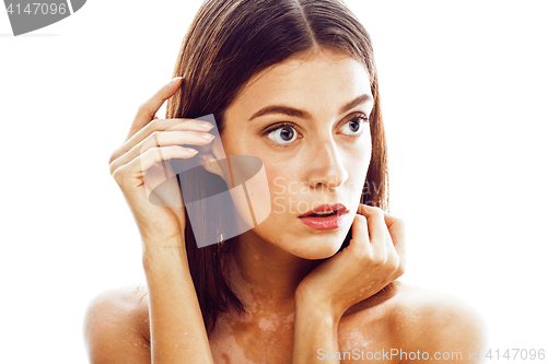 Image of beautiful young brunette woman with vitiligo disease close up isolated on white positive smiling, model problems concept, bad tan problem