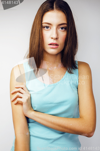 Image of beautiful young brunette woman with vitiligo disease close up isolated on white positive smiling, model problems concept, bad tan problem